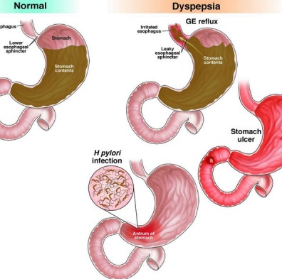 Digestive Disorders Illustration